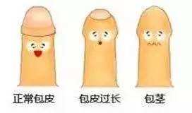 苏州割包茎要多少钱